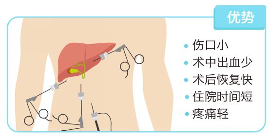 胆囊切除会诱发肝癌吗 胆囊切除会诱发肝癌吗 健康关注|筷子用太久易诱发肝癌，使用6要点你知道几点？