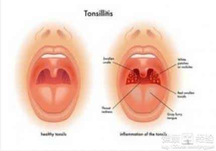 扁桃体发炎盐水漱口 扁桃体发炎的时候，用这种自制的药水漱口就行了，不用非得吃药
