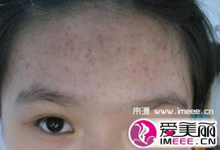 长痘痘的位置图解 额头长痘痘的原因