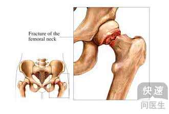 股骨头坏死的发病几率 股骨头坏死的发病几率 太田痣的发病几率