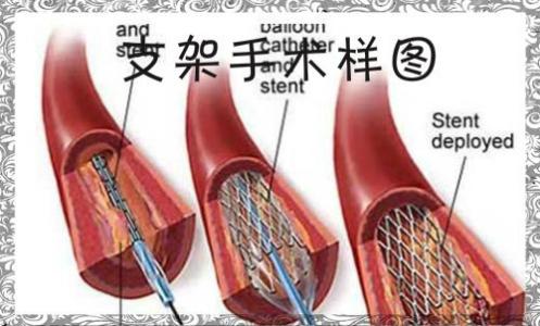 血管堵塞吃什么食物好 【治疗血管堵塞的验方】血管堵塞，一方畅通！