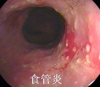 反流性食管炎症状表现 食管炎的早期症状 食管炎早期的表现是什么