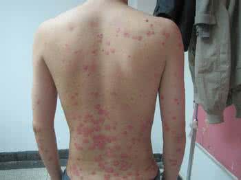 嗯点滴类型银屑病 点滴状银屑病 4种症状你全知道吗