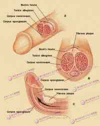 阴茎弯曲矫正小窍门 阴茎弯曲矫正手术过程及注意事项