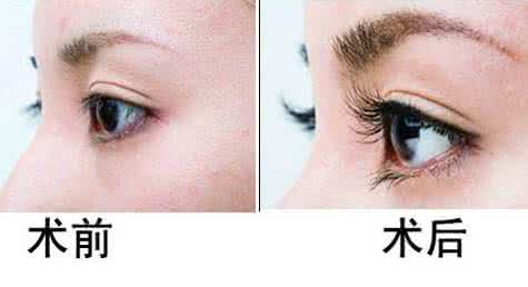 种植睫毛一般多少钱 永久种植睫毛多少钱