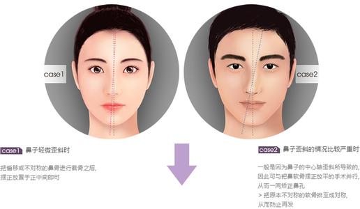 鼻子整形后果 鼻子整形的后果 整形前 请考虑好后果