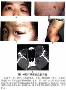 神经纤维瘤病图片 神经纤维瘤病图片(图谱)概述