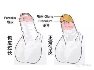 男性假性包皮过长早泄怎么办