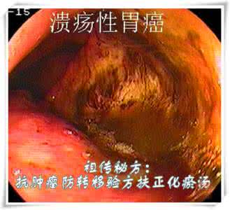 祖传秘方偏方验方大全 祖传秘方：抗肿瘤防转移验方扶正化瘀汤