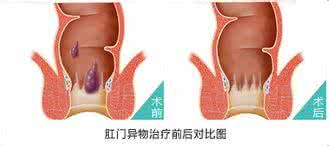 梦见蛔虫从肛门拉出来 梦见别人肛门 梦见肛门