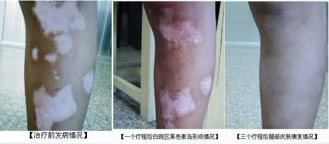 痔疮治疗土方法有奇效 痔疮治疗土方法有奇效 得了白癜风怎么办 4个方法有奇效