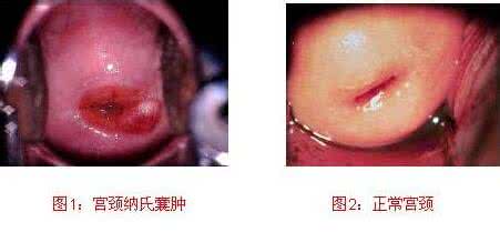 宫颈纳氏囊肿怎样治疗 宫颈纳氏囊肿怎样治疗？