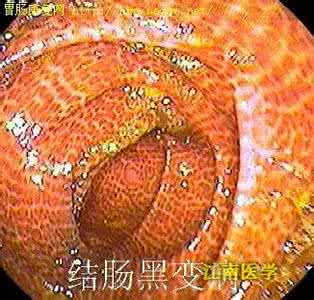 大肠黑变病吃什么调理 结肠黑变病 什么因素致使结肠黑变病发生