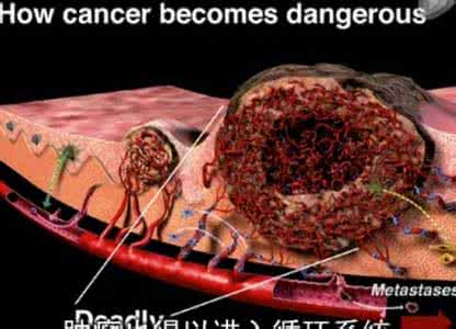 肺肉瘤样癌的治疗方法 癌、瘤的治疗