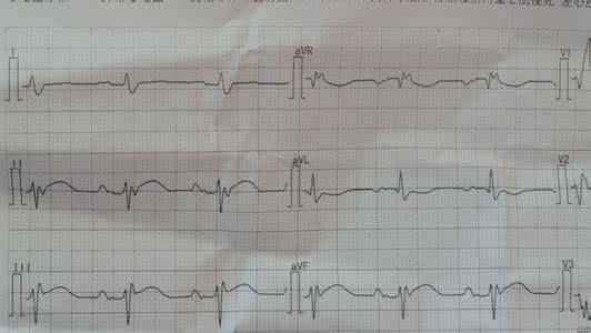 心电图讲解视频 心电学一词一图讲解22--《心电图Wellens综合征》
