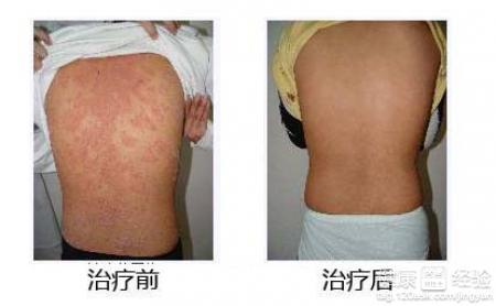 湿疹患者治疗 湿疹治疗是怎样 患者可以用什么方法去护理