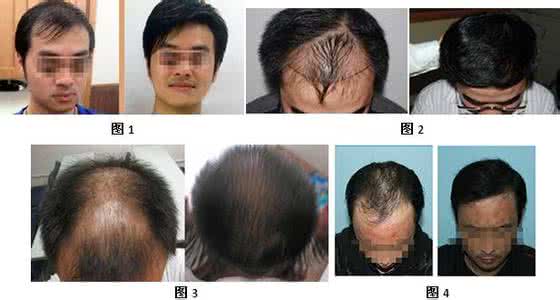 脱发的中医治疗方法 脱发严重怎么治疗 脱发严重的中医治疗方法