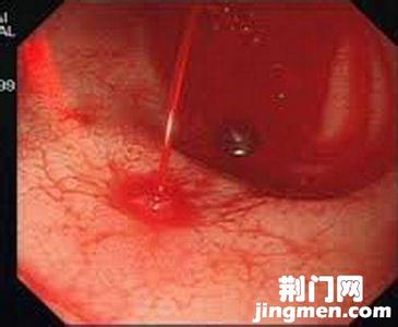 胃溃疡能吃丝瓜吗 胃溃能吃丝瓜吗?