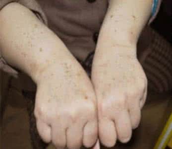 脸上长老年斑怎么治 脸上长老年斑怎么治 运动疗法可治老年斑