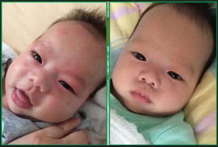 宝宝长湿疹要注意什么 宝宝为什么会得湿疹