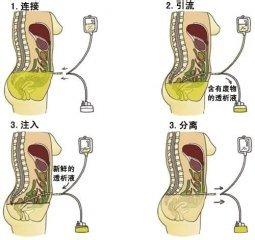 腹膜透析的适应症 腹膜透析适应症 腹膜透析 它的适应症有哪些