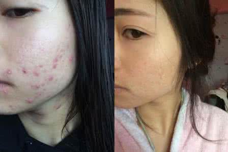 战痘 战“痘”方！
