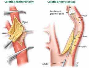 脑血管狭窄怎么治疗 脑血管狭窄 脑血管狭窄怎么治疗