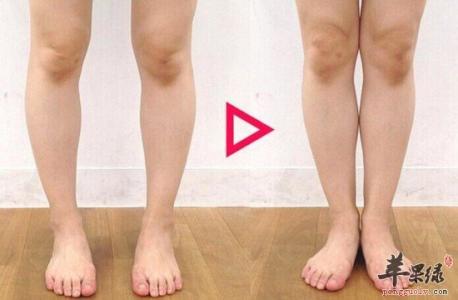 o型腿怎么矫正最有效 如何矫正o型腿