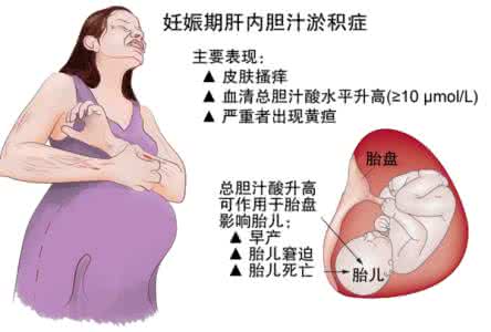 妊娠期肝内胆汁淤积症 警惕妊娠肝内胆汁淤积症