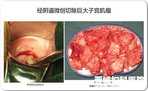 子宫肌腺瘤的治疗方法 子宫肌腺瘤怎么治疗 子宫肌腺瘤的两种治疗方法