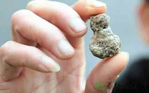 肾结石能吃蚕豆吗 每天忘记做这事肾结石竟有蚕豆大