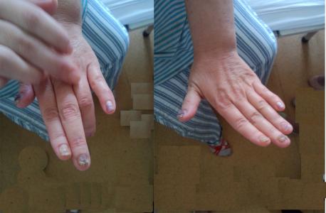 治疗类风湿的新疗法 治疗类风湿的新疗法 风湿＼类风湿断快速根疗法 .转载棨.