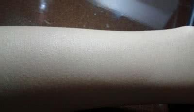 如何治疗鸡皮肤 如何治鸡皮肤 如何治疗鸡皮肤？