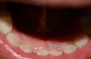 乳牙滞留的危害 乳牙滞留的危害 乳牙滞留 它的危害有哪些