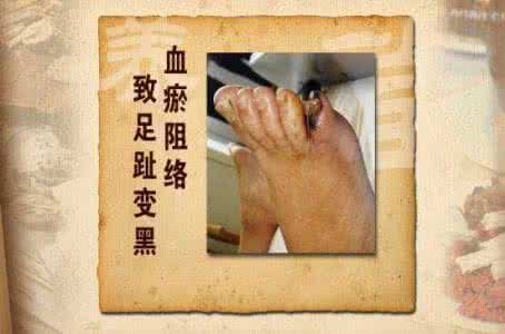 血瘀性头痛 不传秘方:血瘀性头痛六年九剂断根血府逐瘀汤