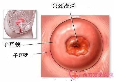 宫颈肥大的治疗方法 宫颈肥大需要治疗吗 宫颈肥大的治疗方法