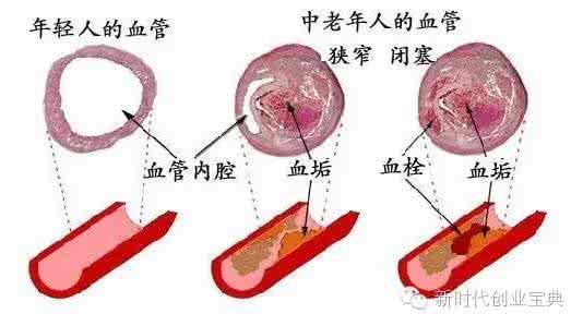 血管不通吃什么 血管不通怎么办 血液不通怎么办？保护血管多吃8种食物