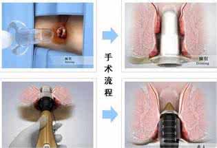 痔疮手术后遗症 痔疮手术后遗症 痔疮手术后遗症 痔疮手术后有什么表现？