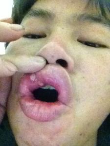 口腔溃疡吃什么药 口腔溃疡