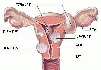 未婚子宫肌瘤怎么办 子宫肌瘤为啥爱上未婚女