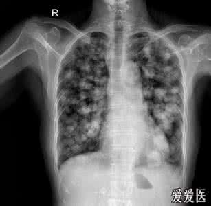 肺部结节是怎么引起的 肺部结节 肺部结节是如何引起的