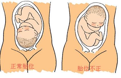 四步手法摸胎位正不正 怎样辨别胎位正不正