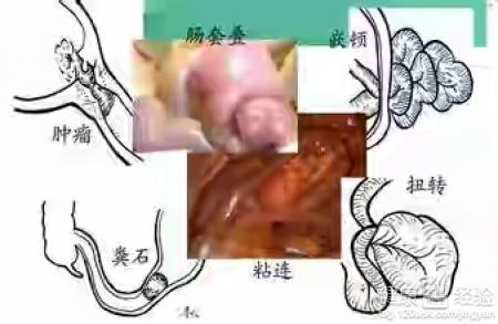 肠梗阻的并发症 肠梗阻有什么并发症 肠梗阻易导致什么并发症