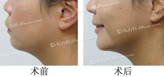 玻尿酸垫下巴的优势 玻尿酸垫下巴的优势 不同垫下巴术的优势对比