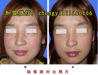 怎么去斑不反弹 中草药去斑法—告别斑点绝不反弹