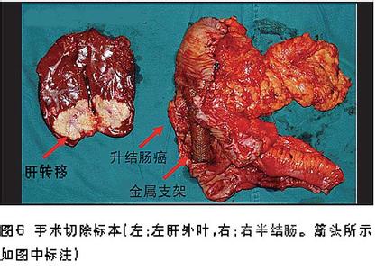 结肠癌肝转移 结肠癌 结肠癌肝转移