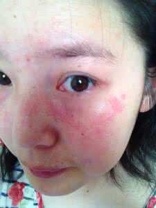 狼疮能活多久 红斑狼疮传染吗