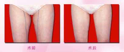 射频溶脂减肥 溶脂减肥多少钱 射频溶脂减肥多少钱