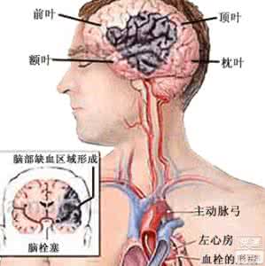 脑梗塞后遗症治疗方法 脑梗塞是什么 脑梗塞的症状和治疗方法