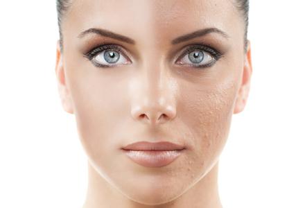 敏感肌肤怎么祛斑 杭州肌肤重建祛斑 激光祛斑让你拥有娇嫩肌肤